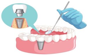 dental implants istanbul turkey