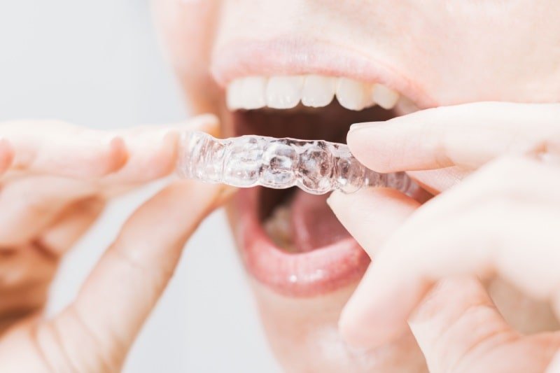 invisalign treatment