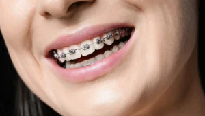 dental bracket treatment