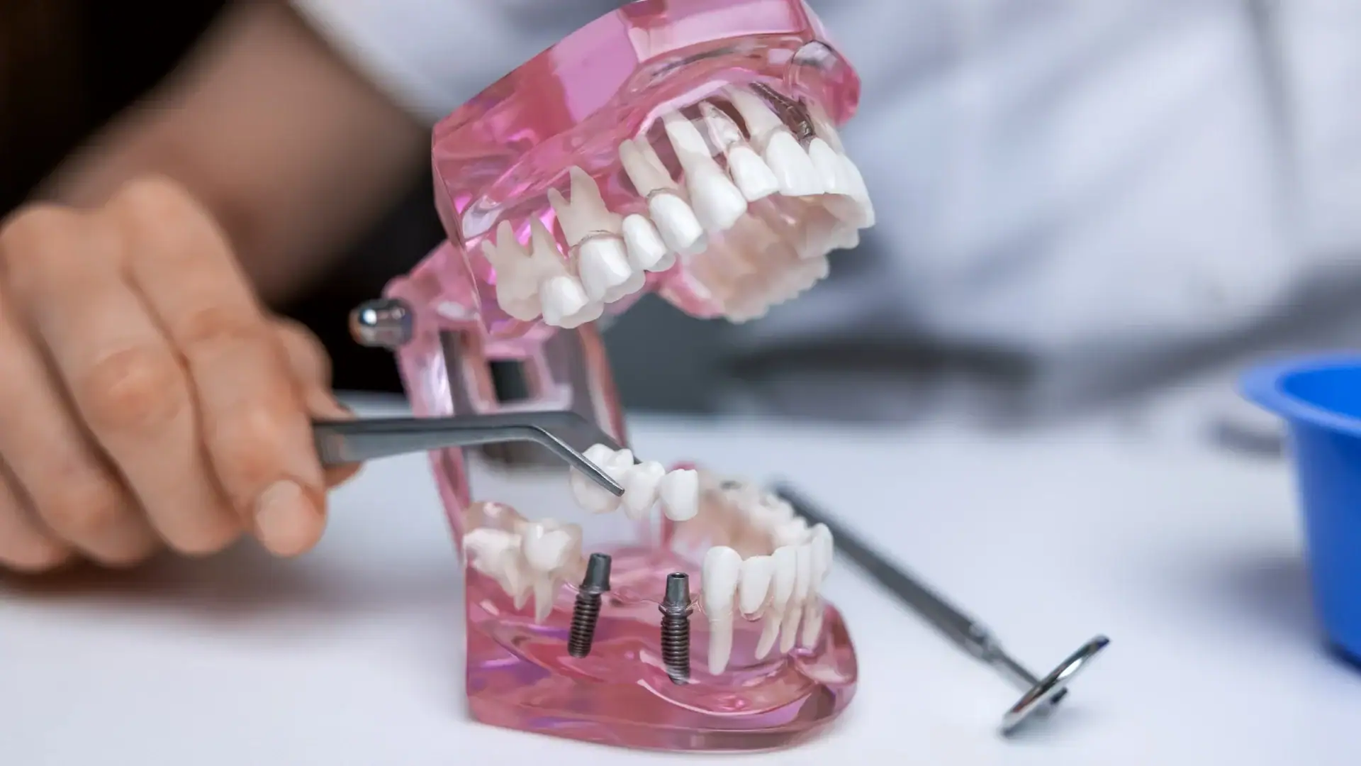 All on 4 Implant Treatment: How is it done, and who is it suitable for?