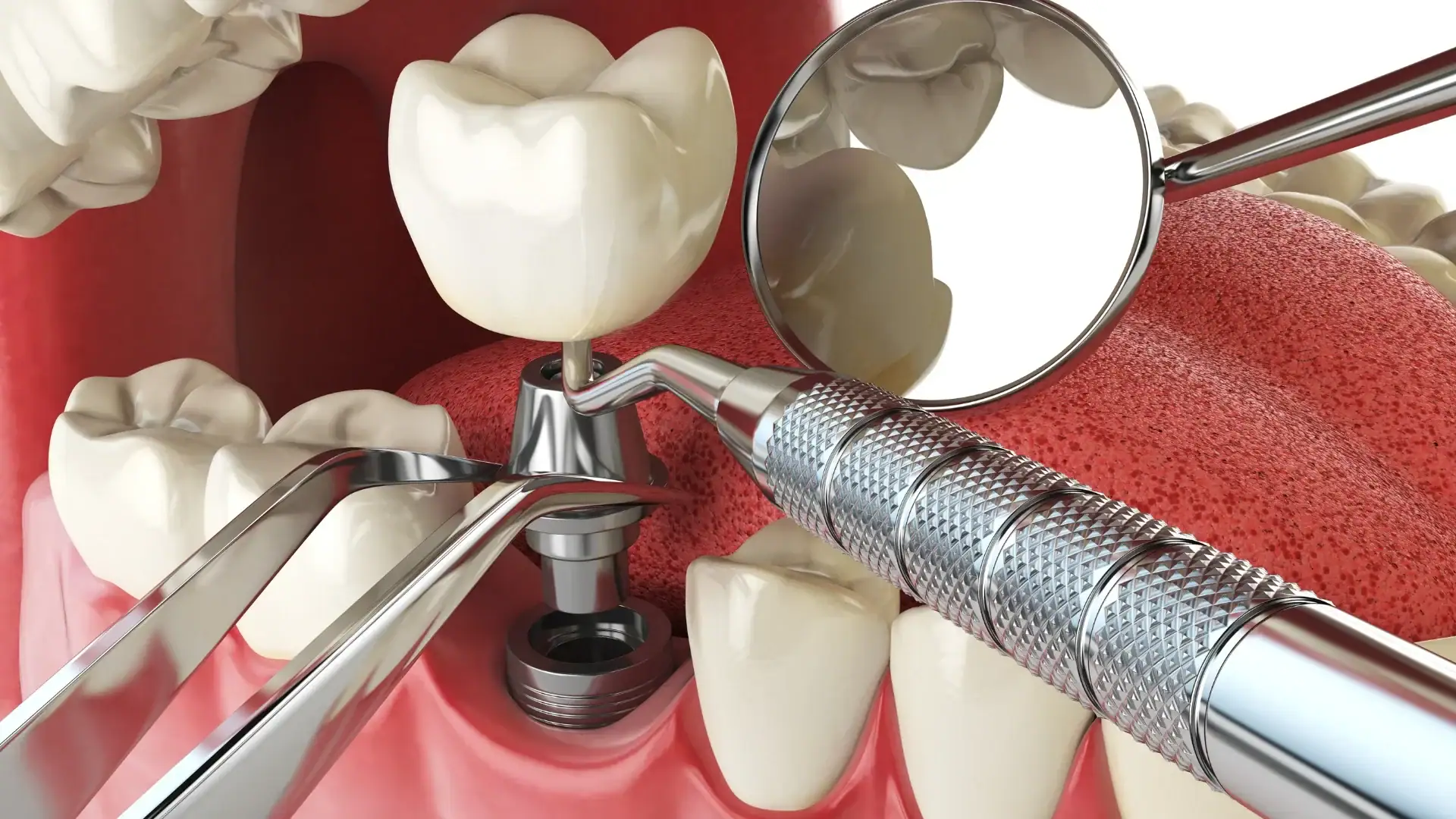 Implant Treatment: Who Is It Suitable For and When Is It Necessary