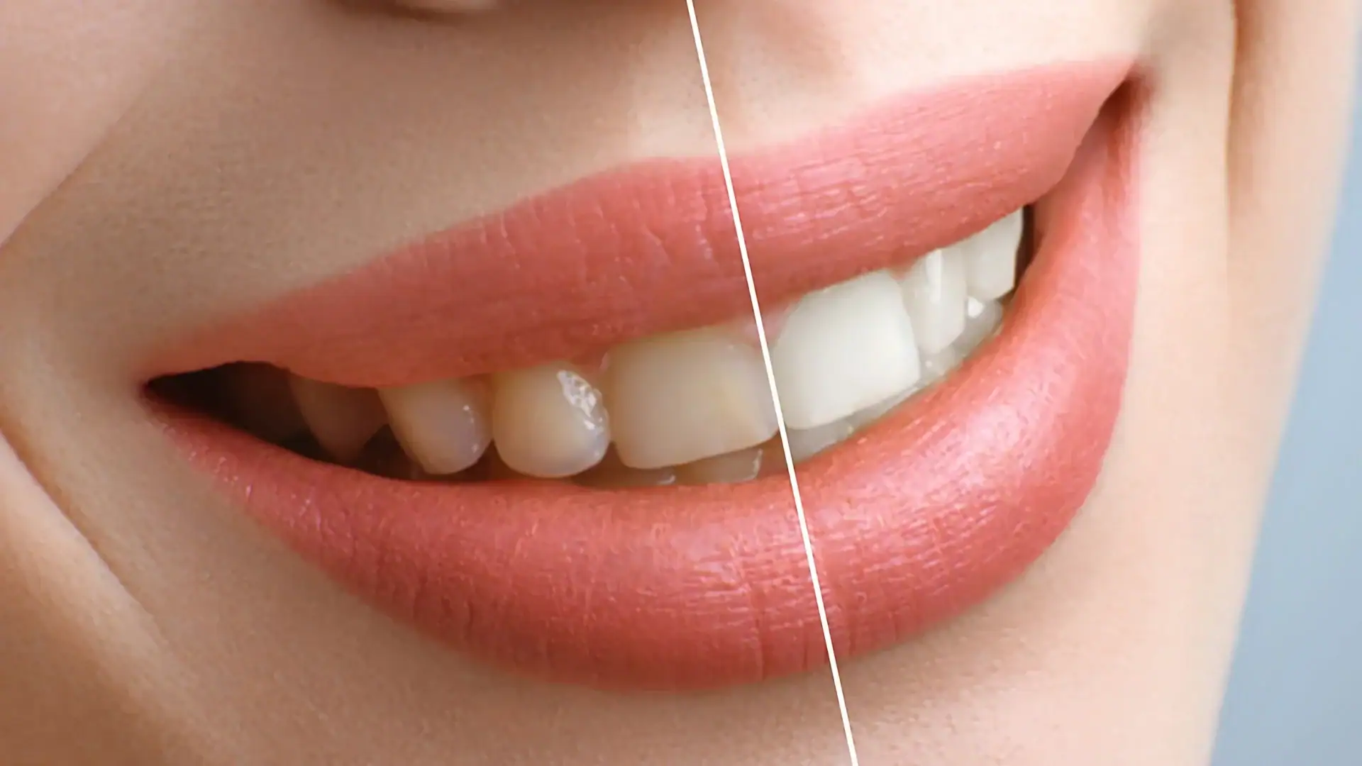 Teeth Whitening Safe and Effective Methods