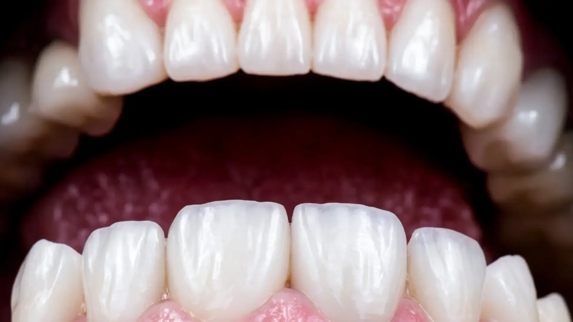 What Are Emax Veneers and Why Are They Preferred in Dental Aesthetics