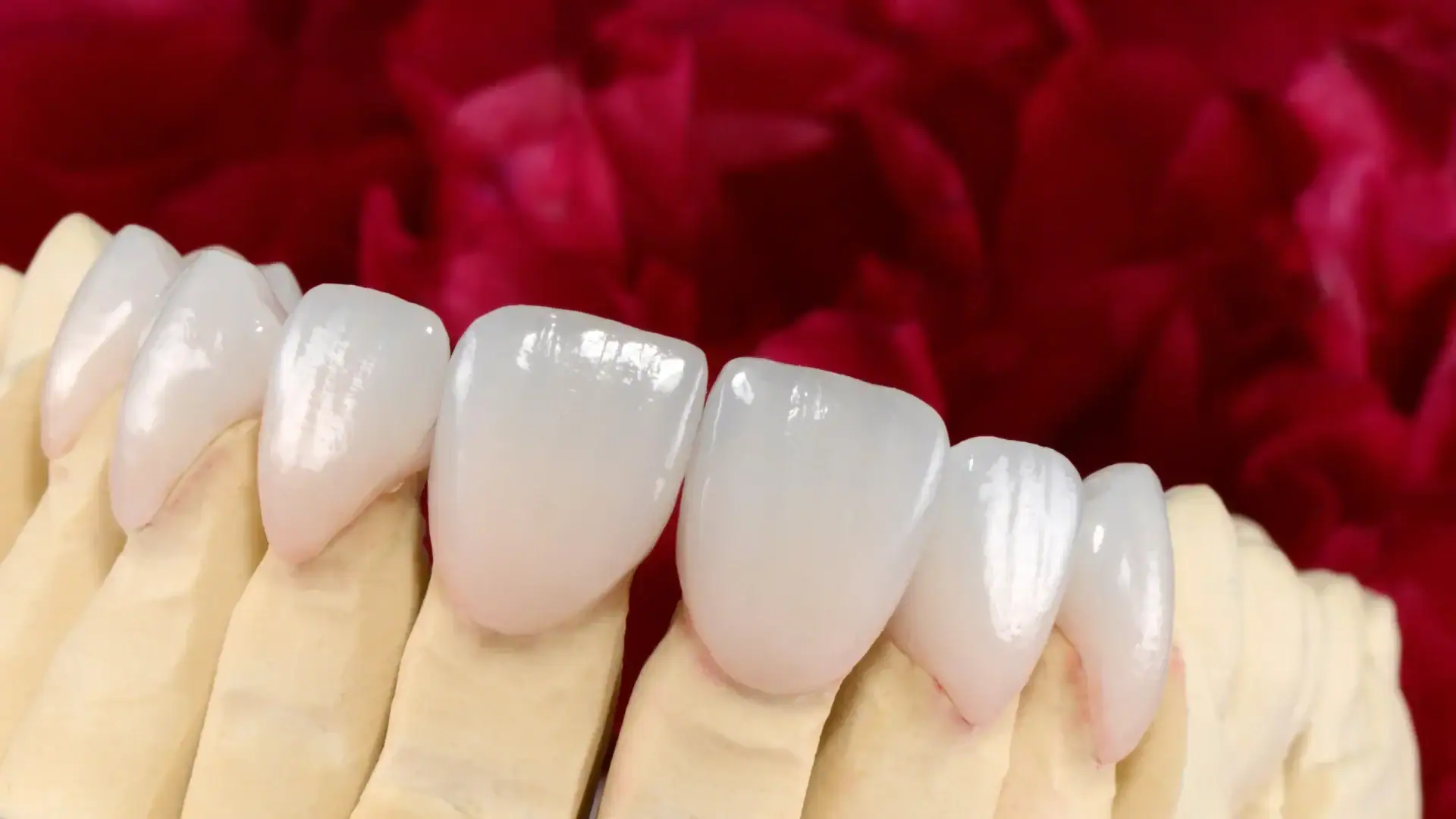 Is Prepless Laminate Treatment Truly Pain-Free? What to Expect for Your Teeth