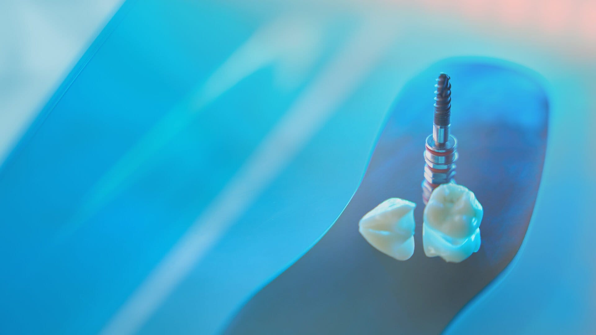 What is a Smart Implant? Technological Transformation in New Generation Dental Treatment