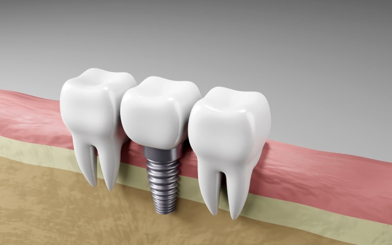 Illustration of a single screw implant placed in bone between two natural teeth