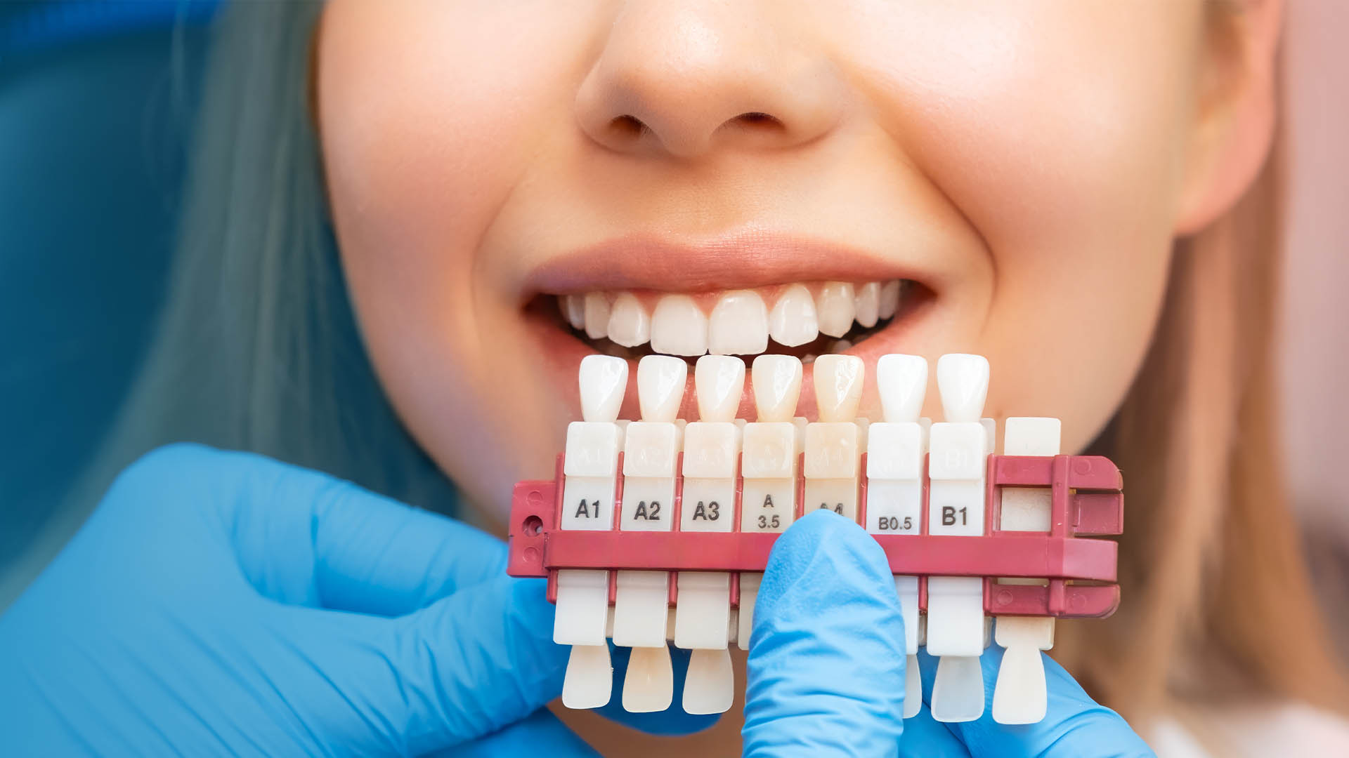 Blue-gloved hand holding a labelled shade guide in front of a woman's smile