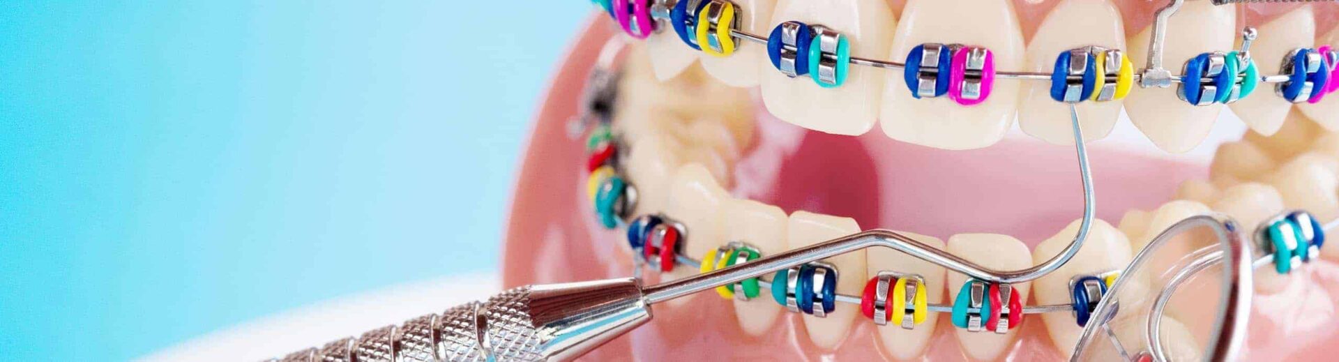 Close-up of brackets with coloured ligatures and an interdental brush under the wire