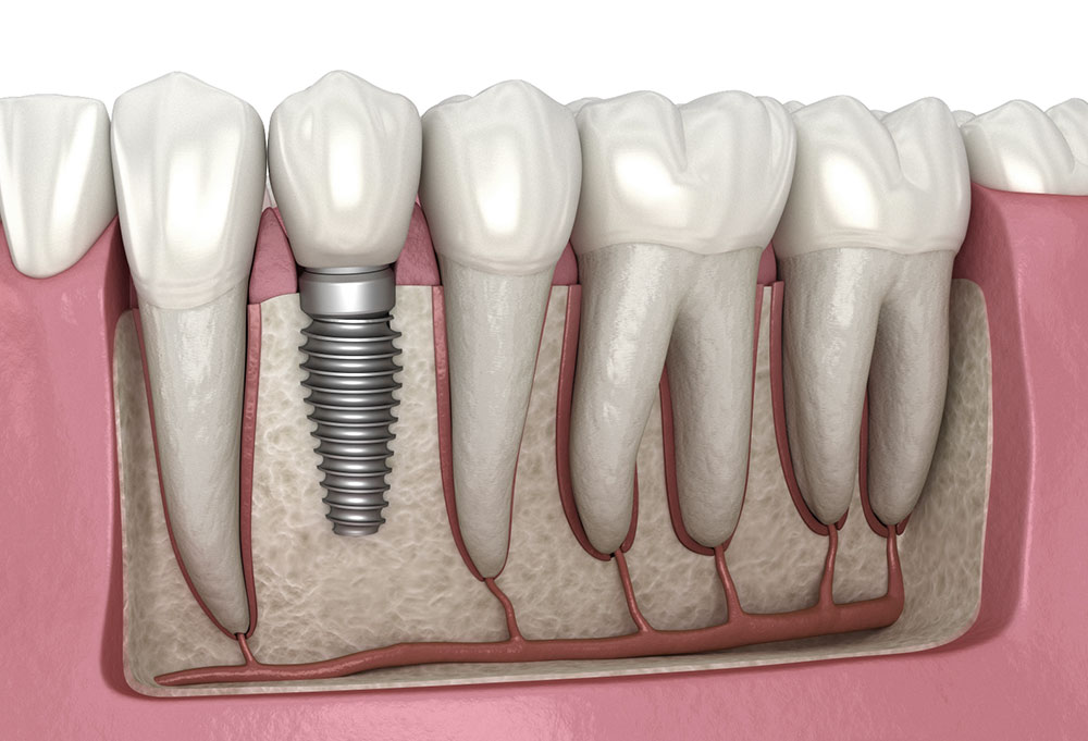 Titanium implant integrating with bone (osseointegration)