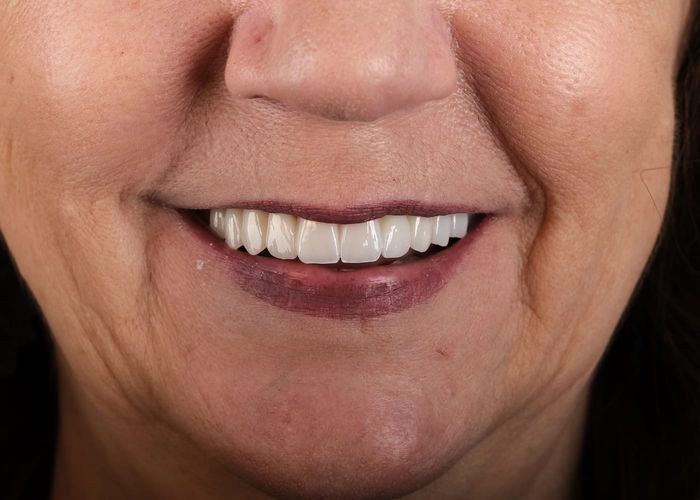 Case 1 · intraoral view after veneers