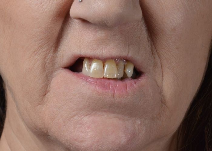 Case 1 · intraoral view before veneers