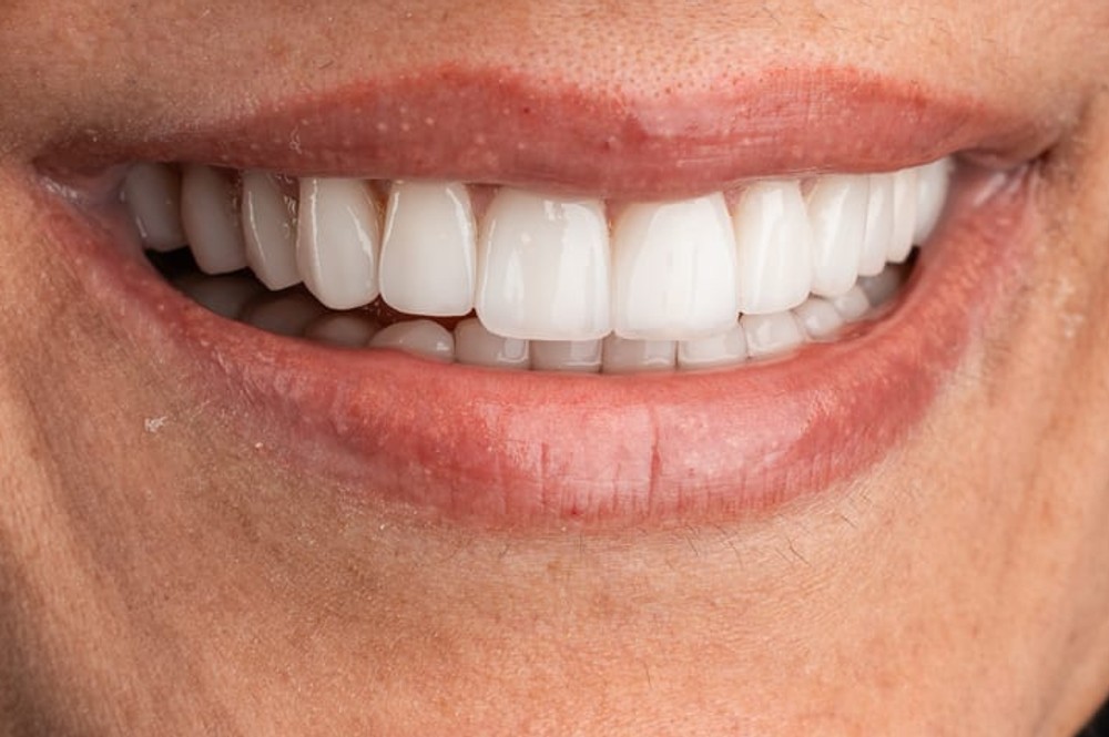 Case 10 · intraoral close-up after treatment