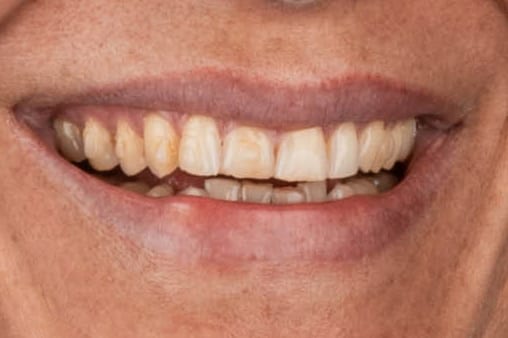 Case 10 · intraoral close-up before treatment