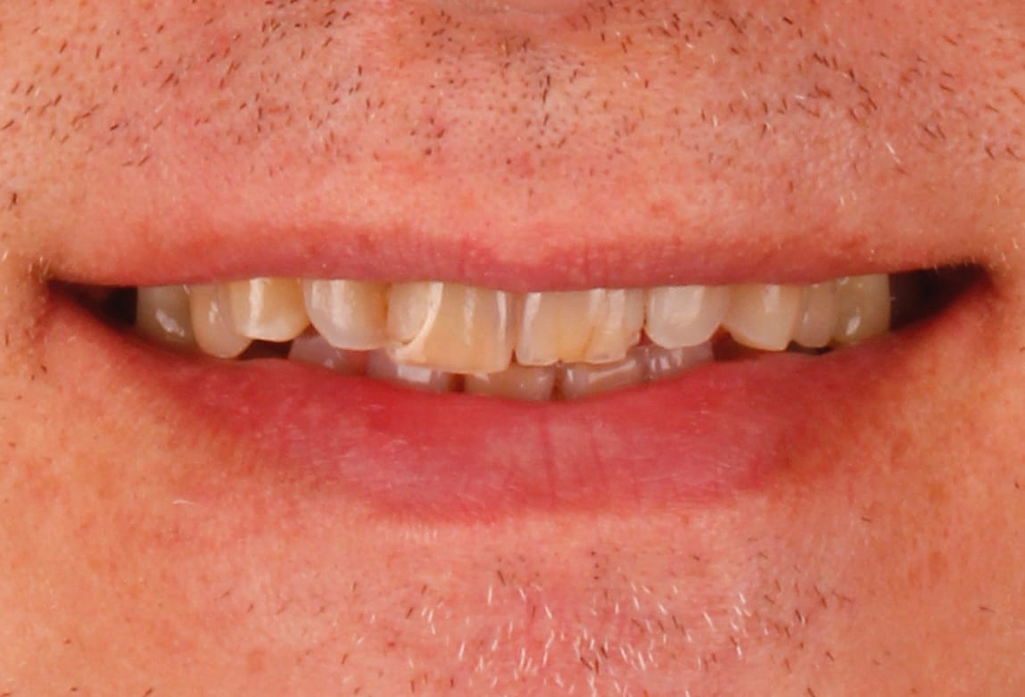 Case 11 · intraoral close-up before treatment