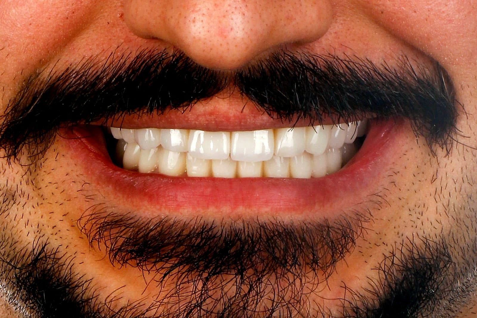 Case 12 · intraoral close-up after treatment