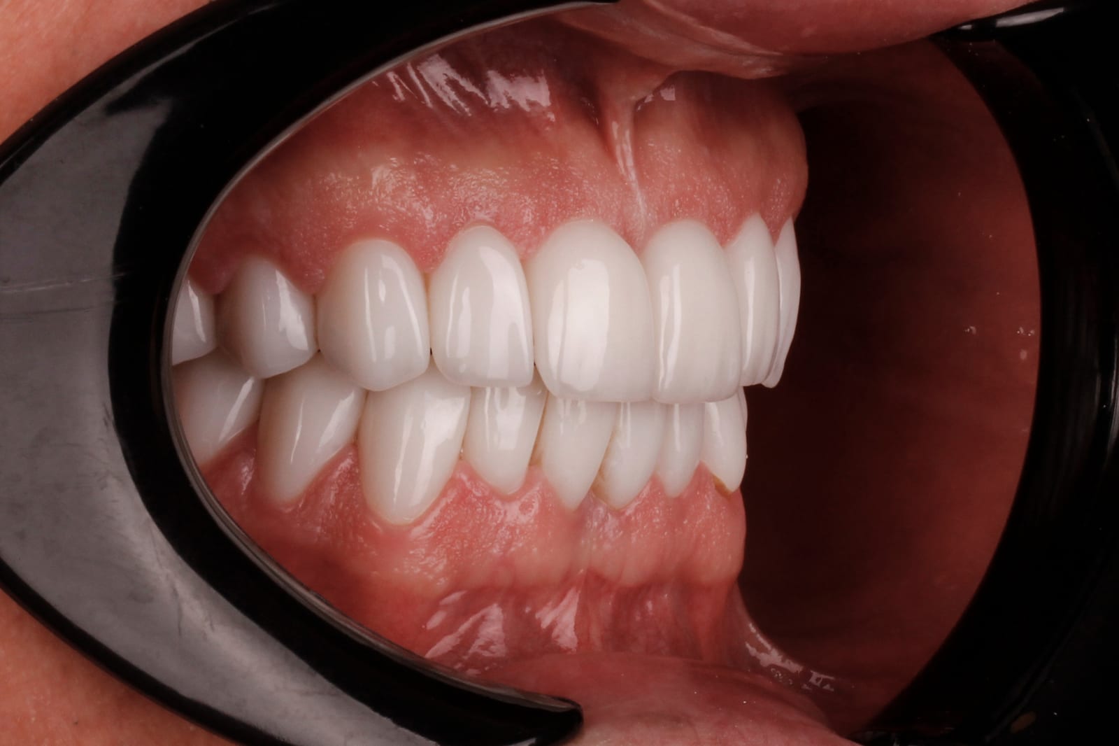 Case 13 · intraoral close-up after treatment
