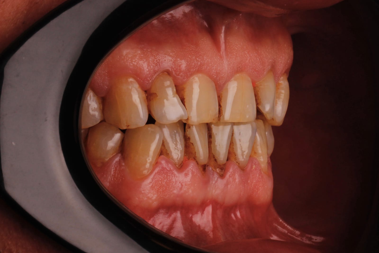Case 13 · intraoral close-up before treatment