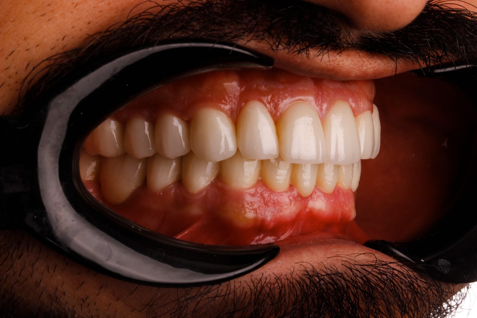 Case 14 · intraoral close-up after treatment