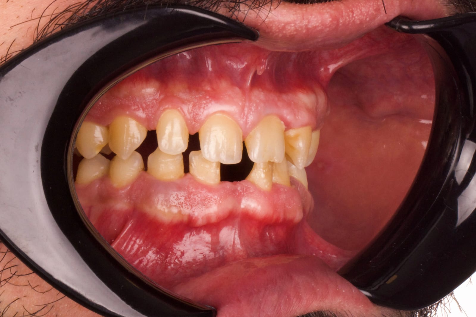 Case 14 · intraoral close-up before treatment