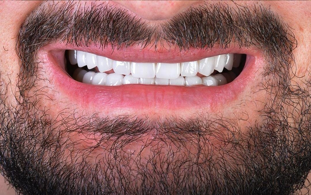 Case 3 · intraoral view after veneers