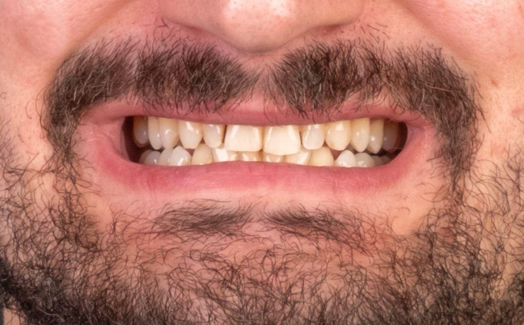 Case 3 · intraoral view before veneers