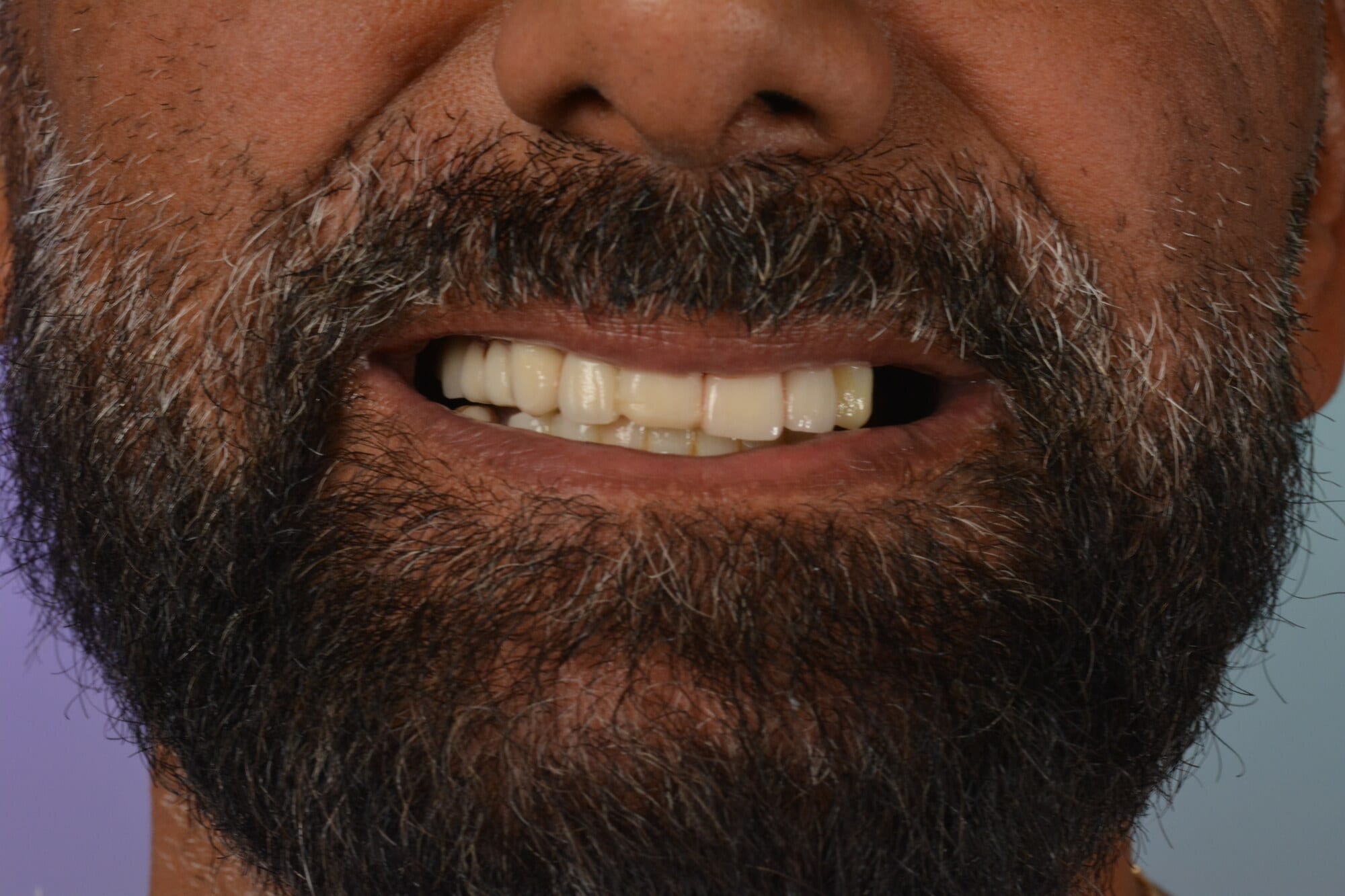 Case 17 · intraoral close-up before treatment