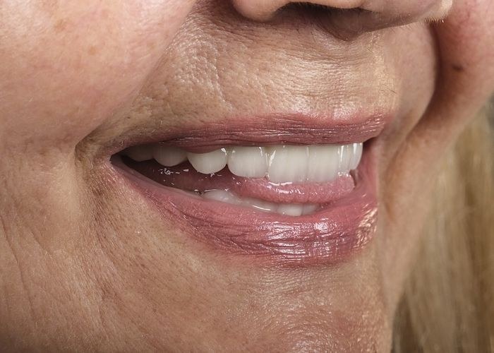 Case 18 · intraoral close-up after treatment