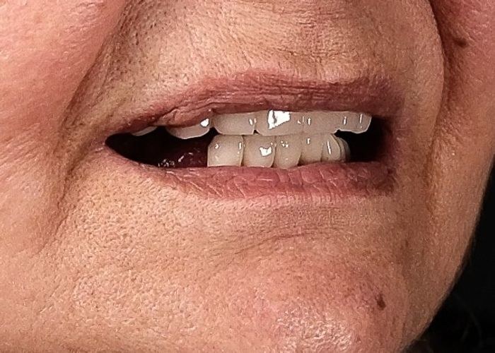 Case 18 · intraoral close-up before treatment