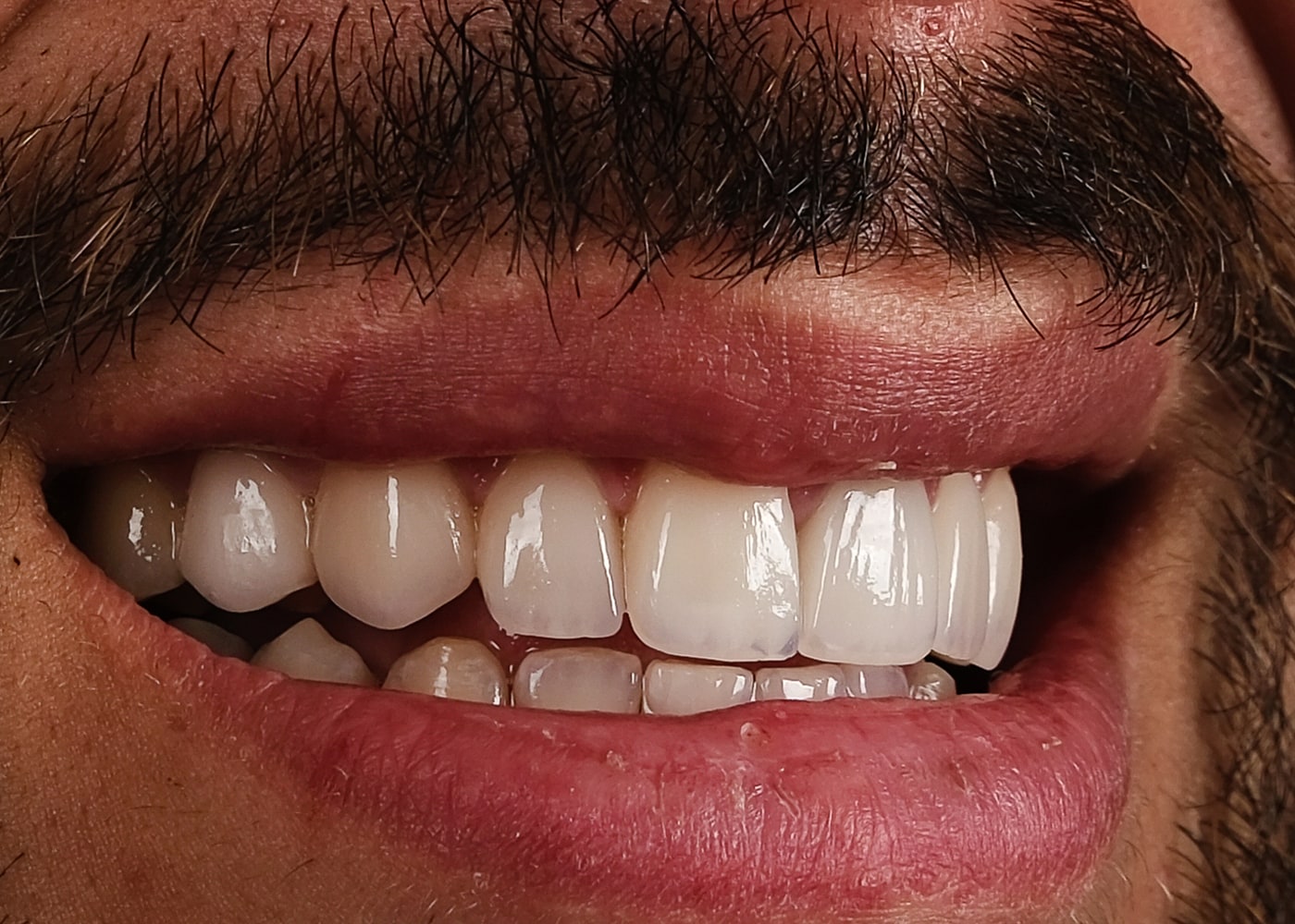 Case 19 · intraoral close-up after treatment