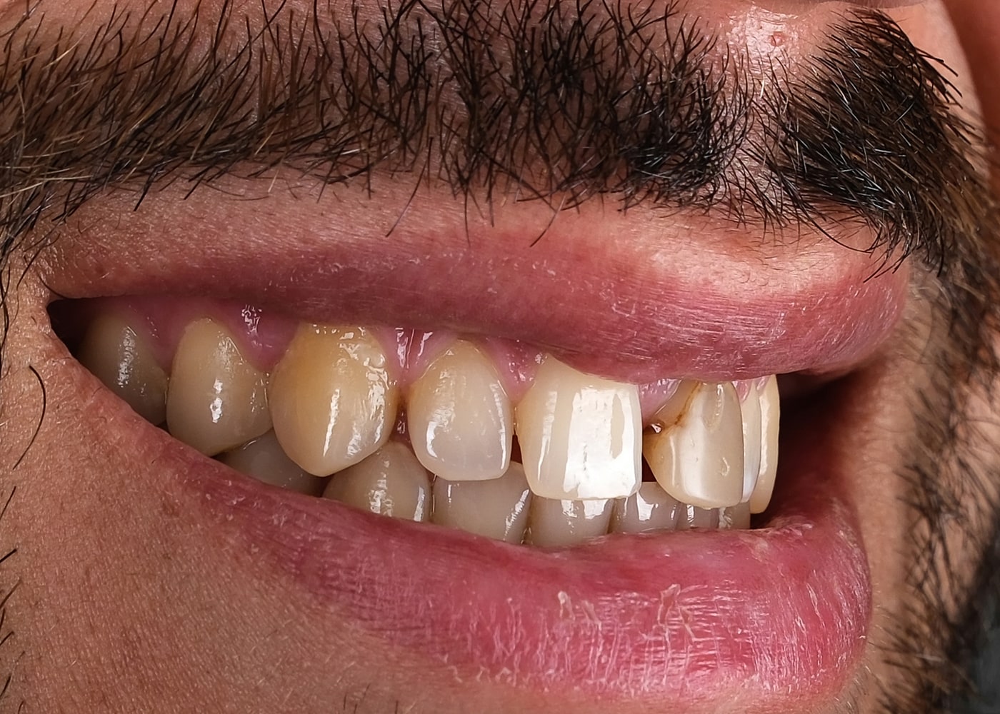 Case 19 · intraoral close-up before treatment