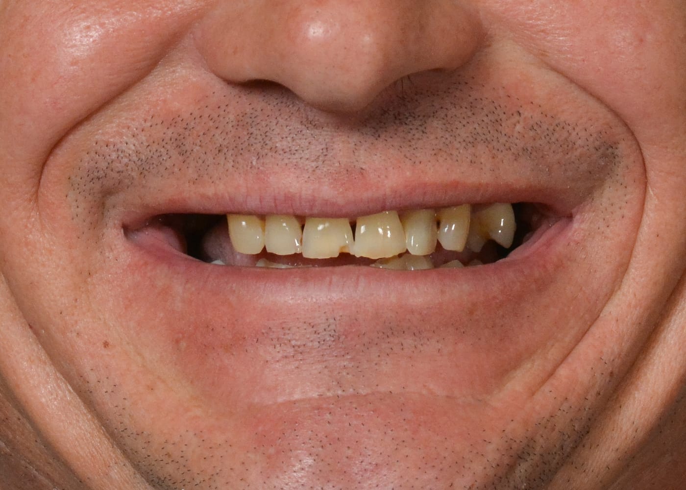 Case 2 · intraoral close-up before treatment