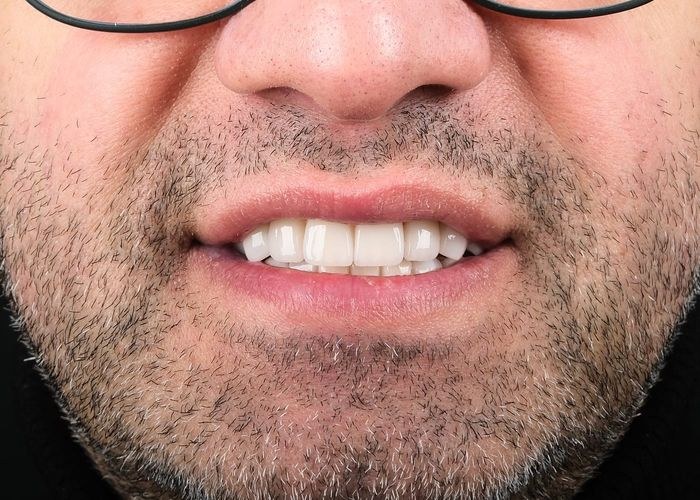 Case 3 · intraoral close-up after treatment