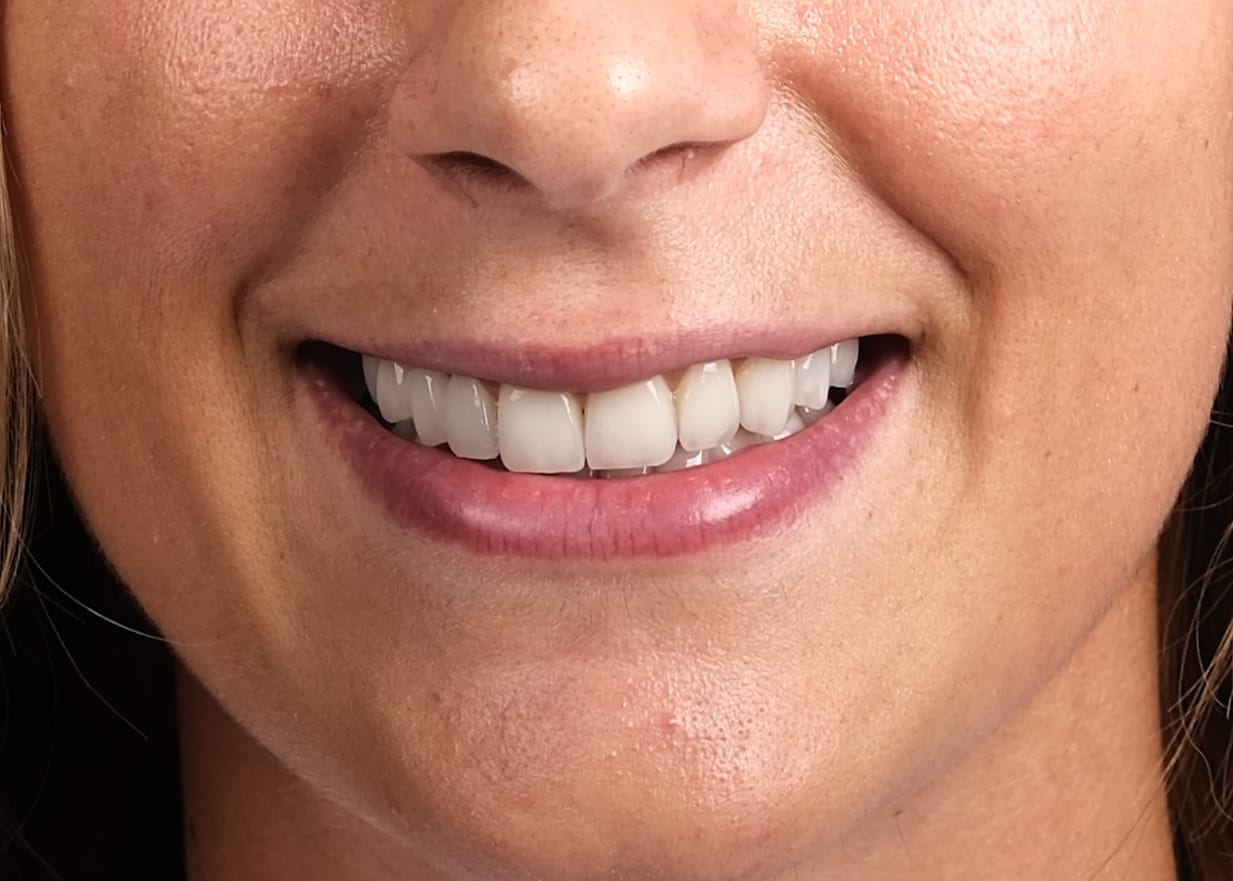 Case 4 · intraoral close-up after treatment