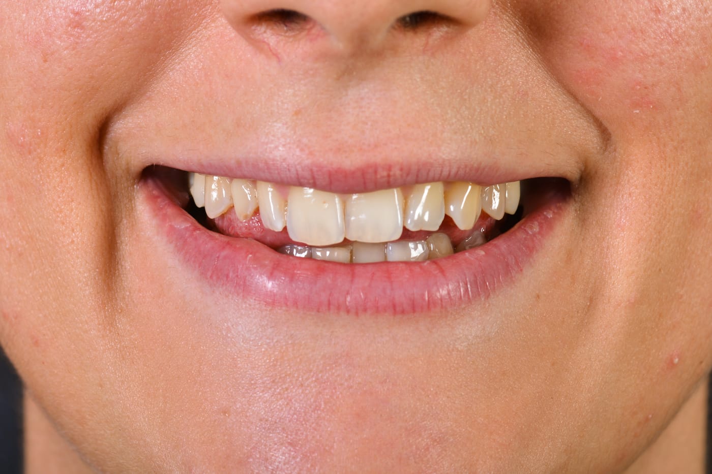 Case 4 · intraoral close-up before treatment