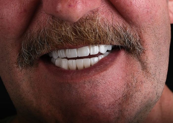 Case 5 · intraoral close-up after treatment
