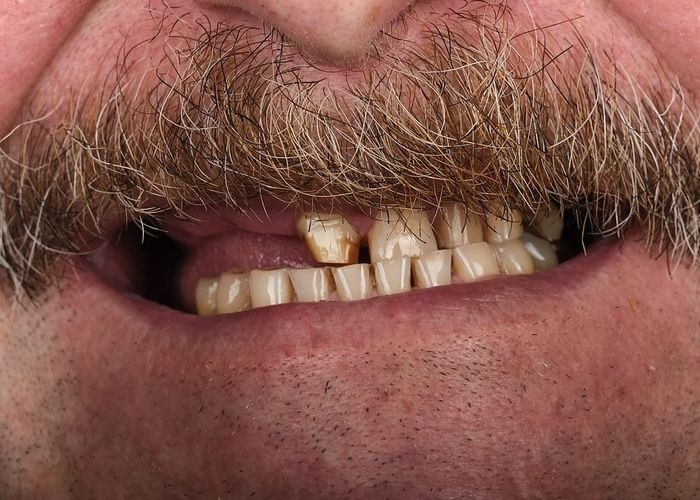 Case 5 · intraoral close-up before treatment