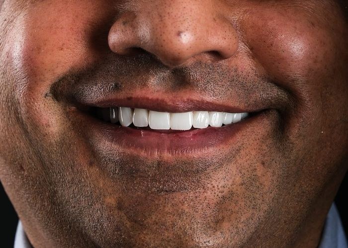 Case 2 · intraoral view after veneers