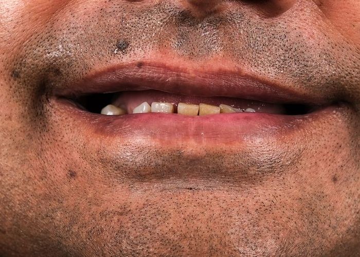 Case 2 · intraoral view before veneers