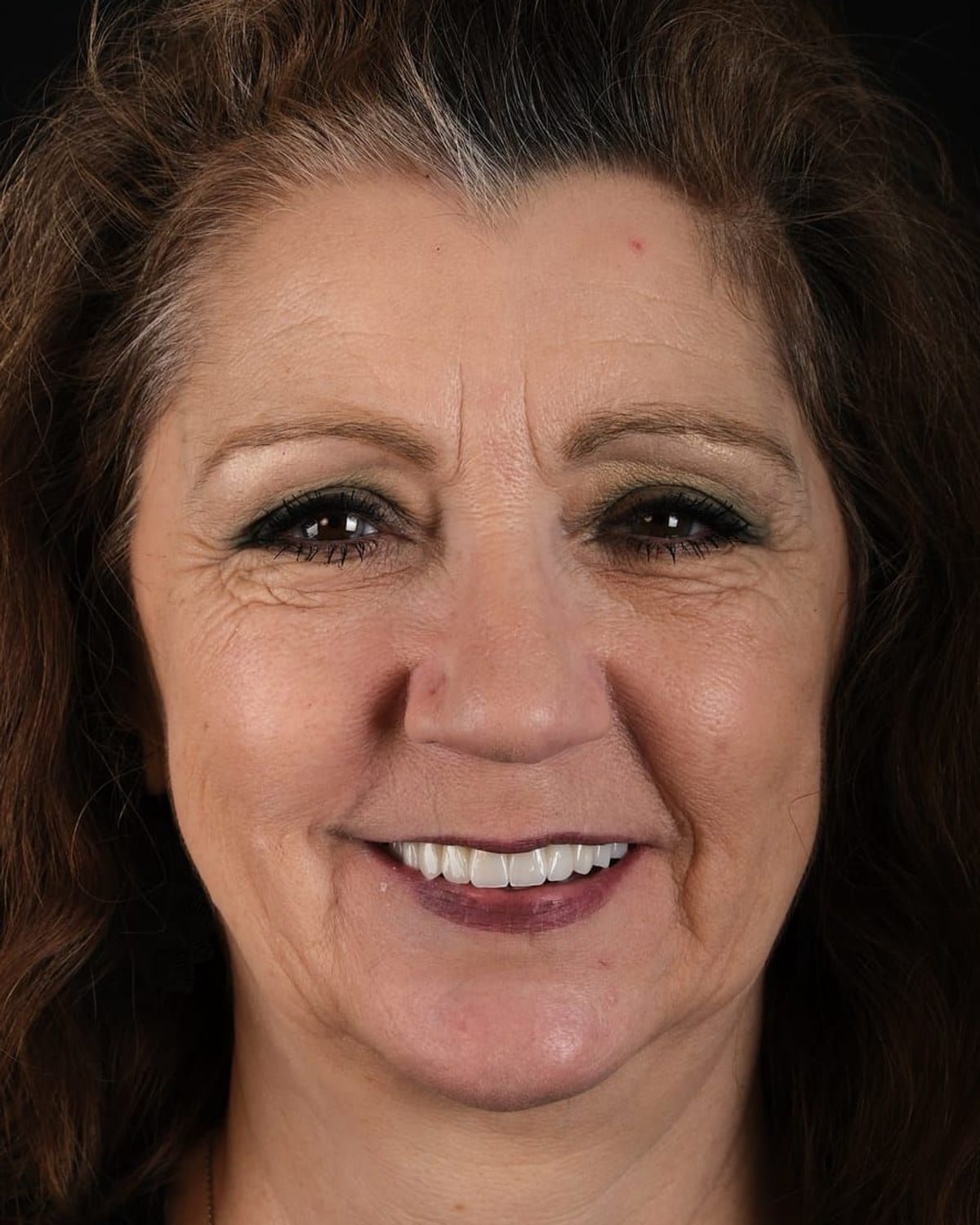 Case 2 · smile portrait after treatment