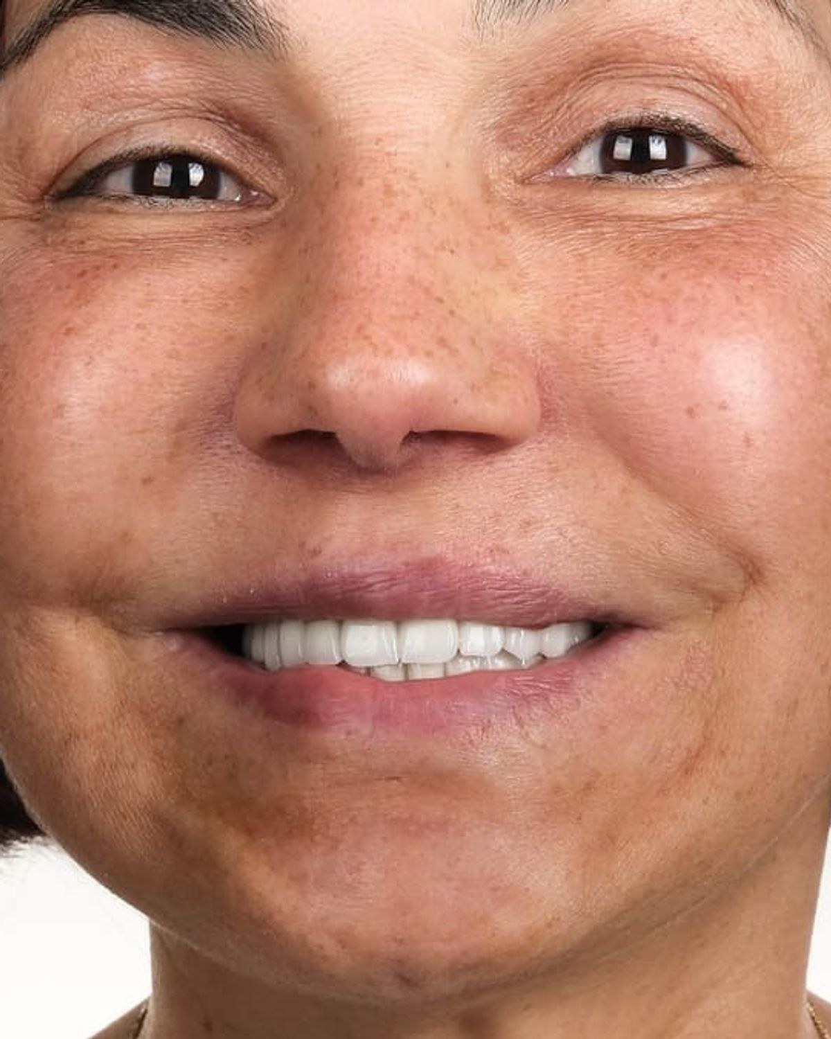 Case 4 · smile portrait after treatment
