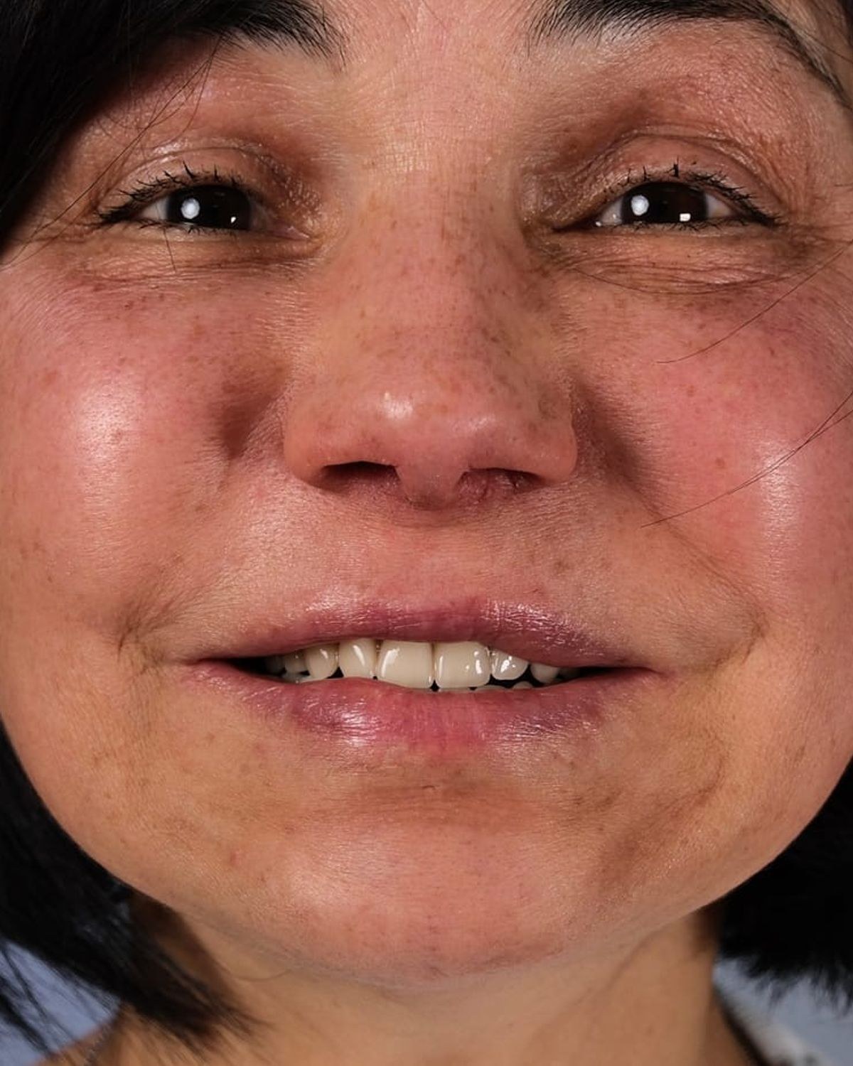 Case 4 · smile portrait before treatment