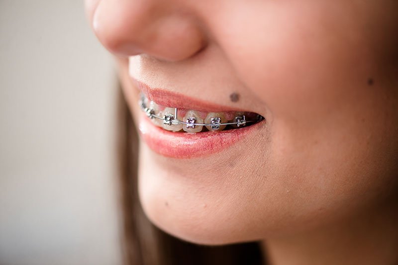 Bracket