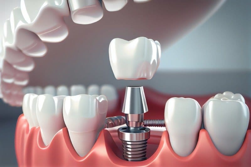 All-on-4 Implants