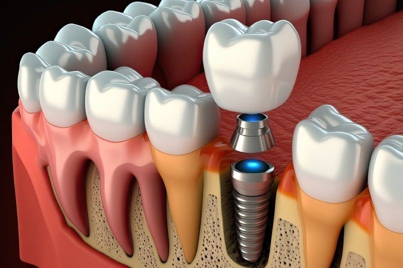 All-on-6 Implants