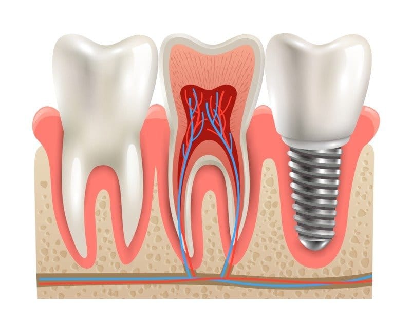 Bone Graft (Membrane)