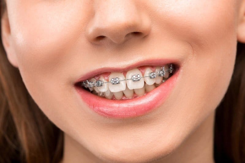 Bracket Treatment