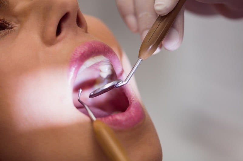 Composite Filling