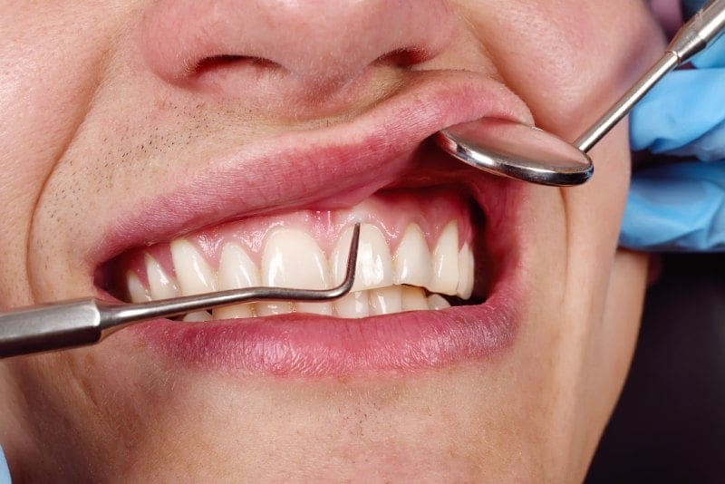 Gum Surgery