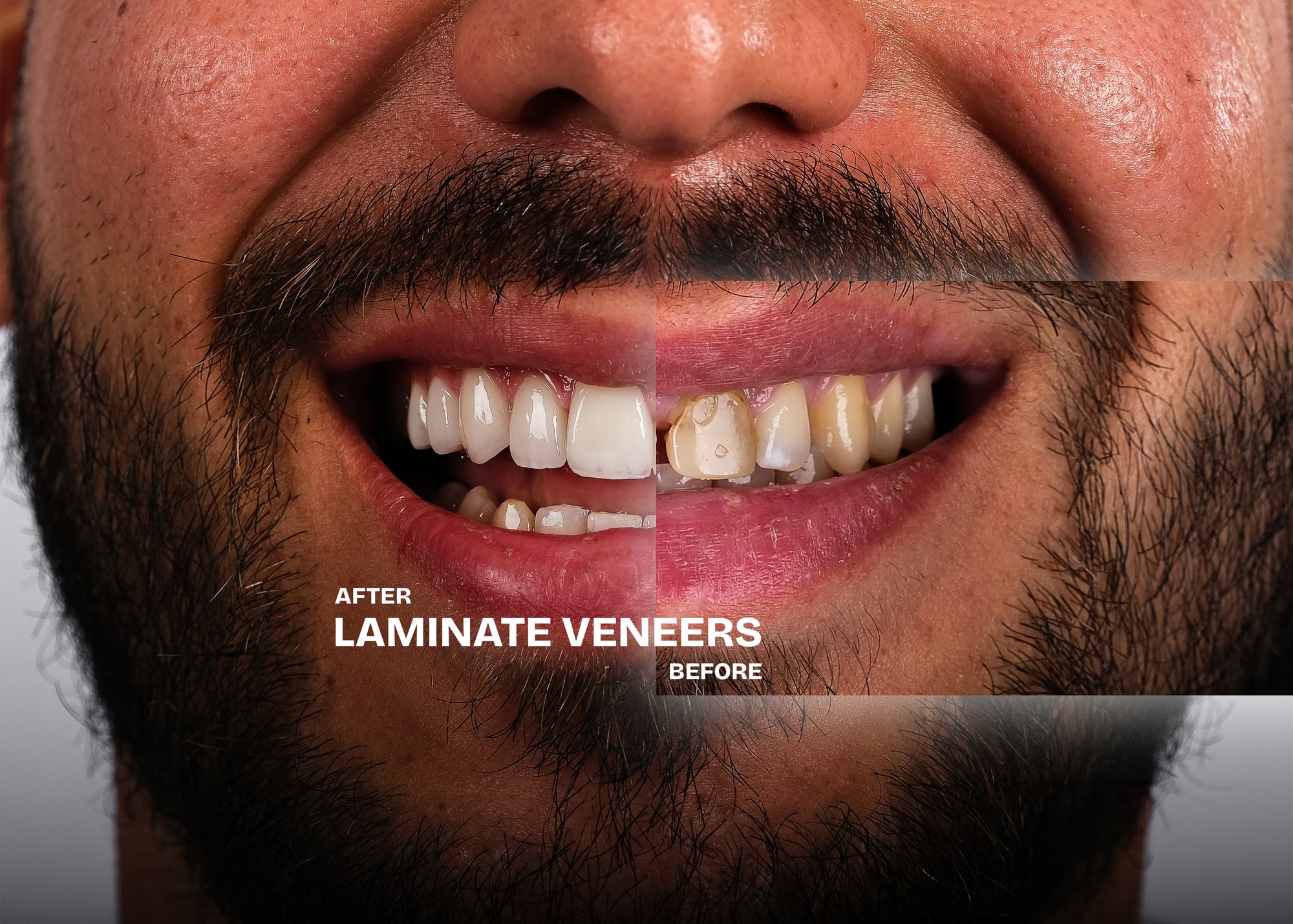 Laminate veneers before and after: the same smile, side by side