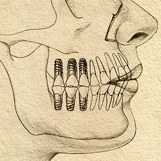 Counterfeit Dental Implants: